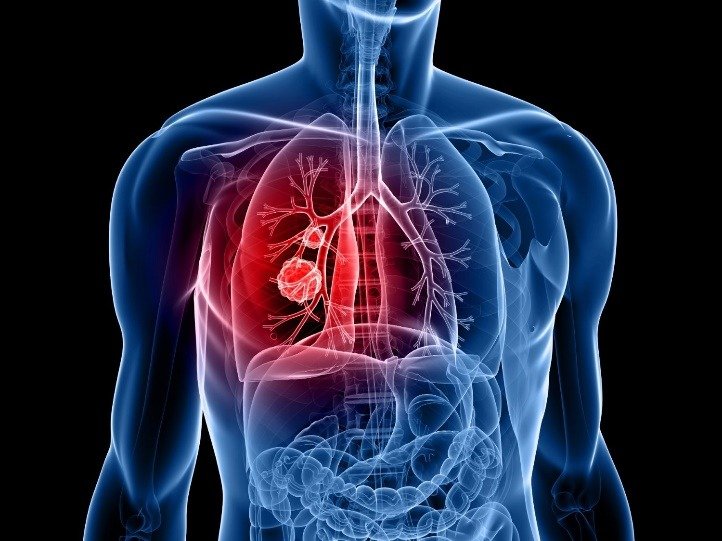 Khái niệm ung thư phổi - Ảnh 2