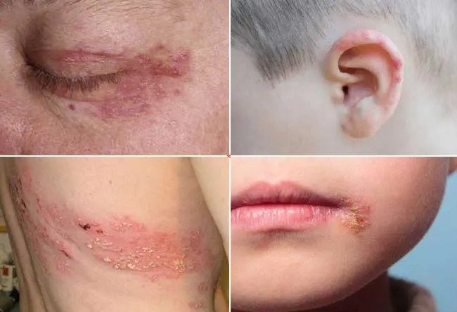 Bệnh zona cũng là một trong những bệnh ngoài da thường gặp nhất tại các phòng khám da liễu - Ảnh 5