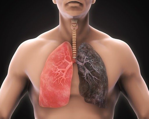 Dấu hiệu nhận biết ung thư phổi di căn khi lan tới tuyến thượng thận - Ảnh 6