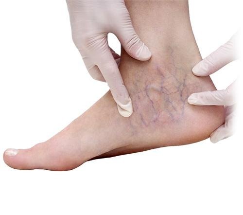 Bệnh suy giãn tĩnh mạch chân là một loại bệnh gây nên hiện tượng sưng, phù nề ở chi dưới - Ảnh 2