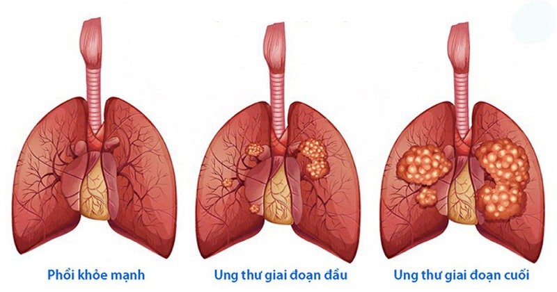 Các dấu hiệu ung thư phổi qua từng giai đoạn bạn nên biết - Ảnh 3