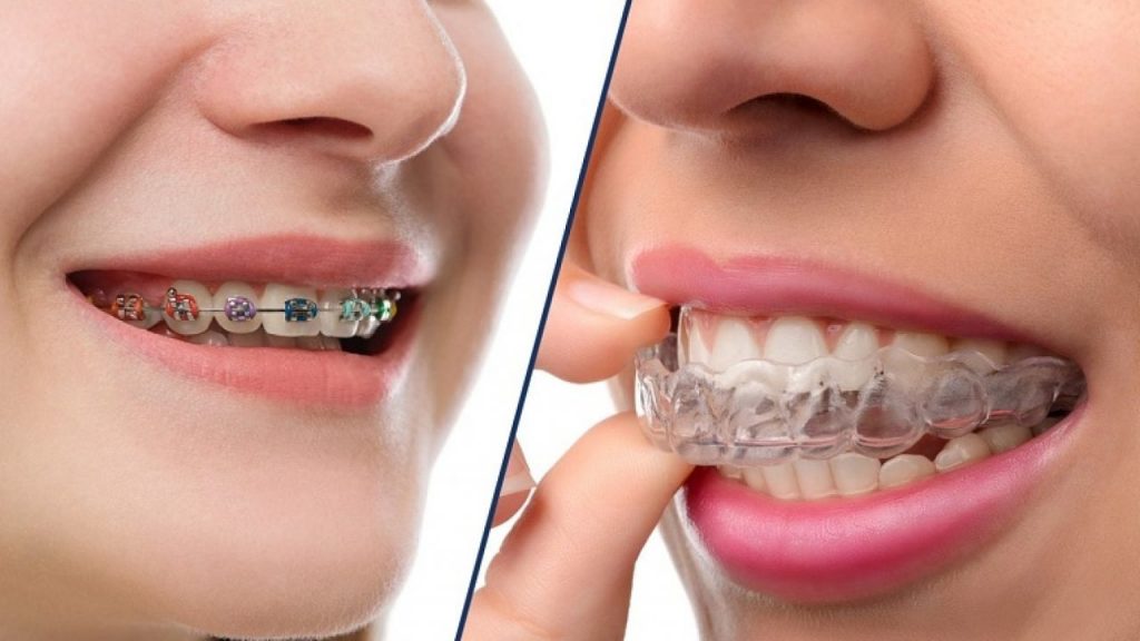 Các vấn đề về răng miệng cũng ảnh hưởng đến giá niềng răng - Ảnh 6