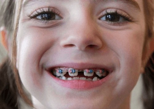 Giá niềng răng mắc cài kim loại cho trẻ em - Ảnh 3