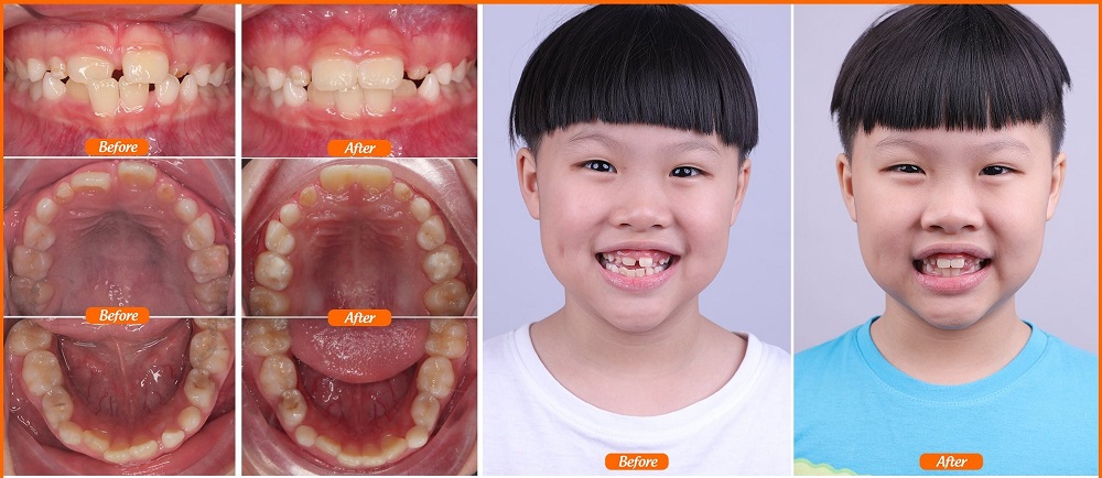 Trẻ ở độ tuổi nào có thể niềng răng chỉnh nha? - Ảnh 1