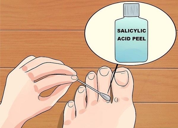 Cách chữa trị mụn cóc ở chân hiệu quả bằng Axit salicylic - Ảnh 6