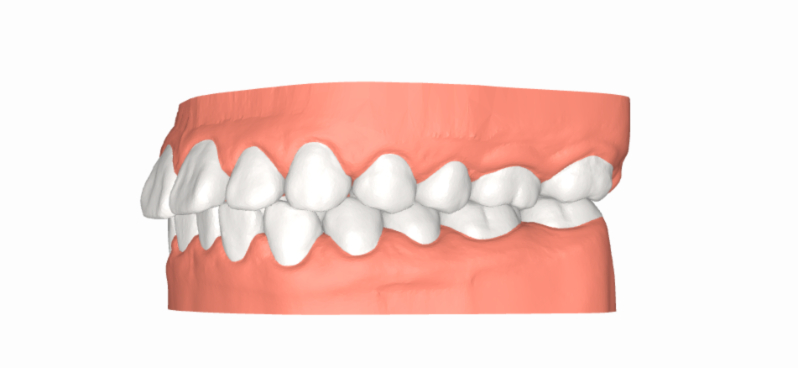 Tình trạng răng hô vẩu - Ảnh 3