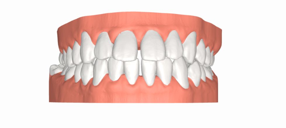 Tình trạng răng thưa - Ảnh 2