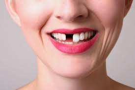 Những trường hợp niềng răng không nhổ răng - Ảnh 5