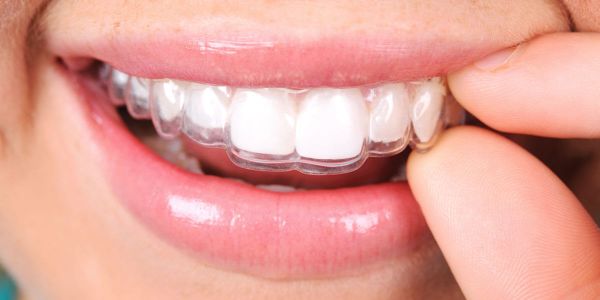 Những lý do chỉ nên niềng răng hàm trên hoặc dưới - Ảnh 2