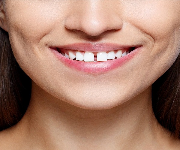 Tình trạng răng thưa (Khoảng trống giữa các răng) - Ảnh 2