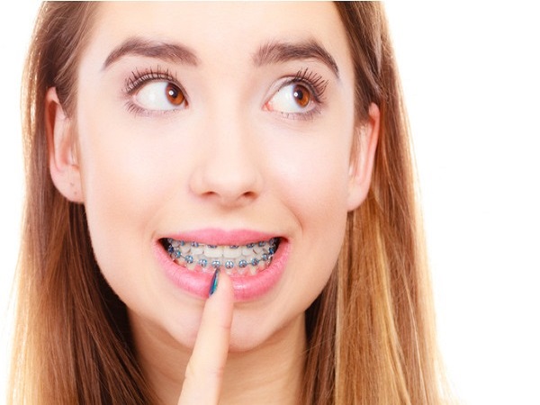 Niềng răng kim loại là lựa chọn tốt nhất cho các vấn đề răng miệng nặng - Ảnh 1