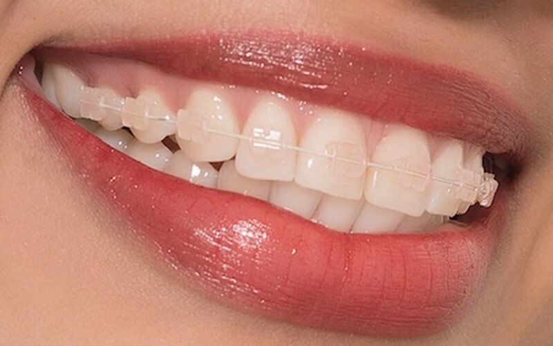 Những điều cần cân nhắc khi niềng răng 1 hàm - Ảnh 5