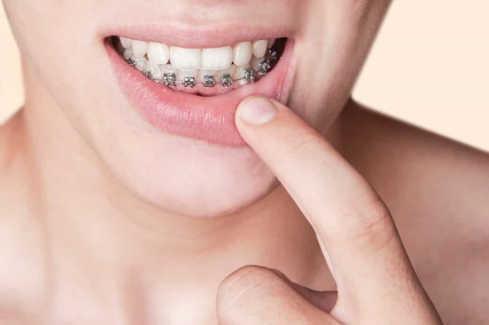Niềng răng 1 hàm là gì? Áp dụng cho đối tượng nào?