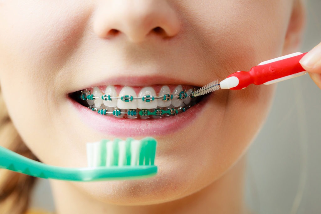 Bạn chăm sóc răng miệng như thế nào khi niềng răng thẩm mỹ? - Ảnh 5