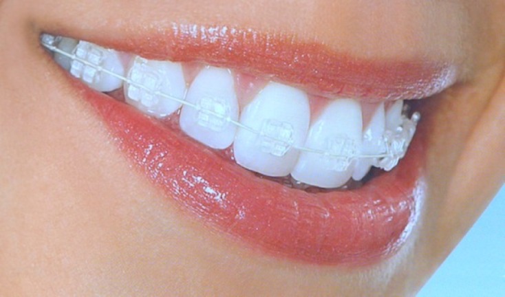 Phương pháp niềng răng mắc cài sứ - Ảnh 3