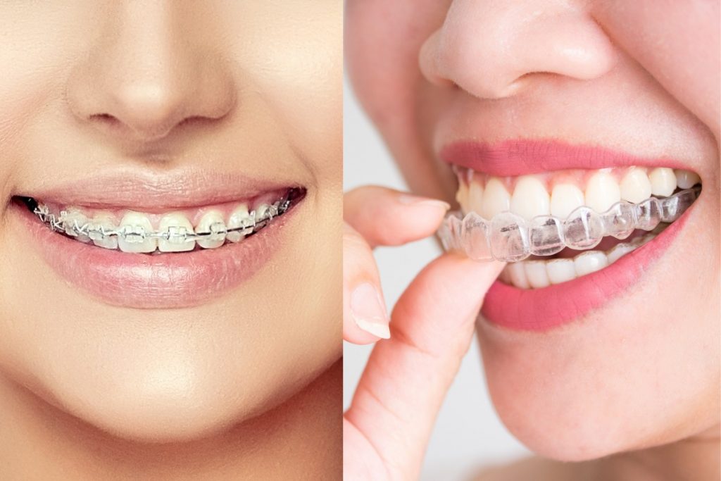 Các phương pháp niềng răng phổ biến hiện nay - Ảnh 1