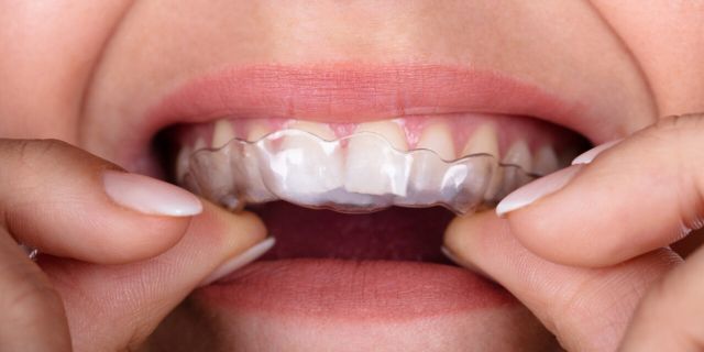 Nên lựa chọn niềng răng trong suốt hay niềng răng mắc cài - Ảnh 5