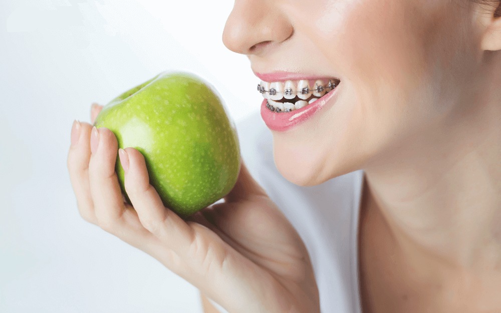 hực phẩm nên tránh khi niềng răng - Ảnh 5