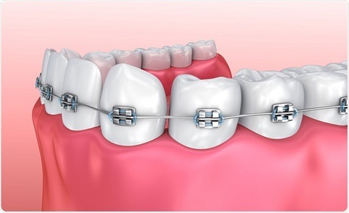 Những điều bạn cần biết về niềng răng hàm dưới