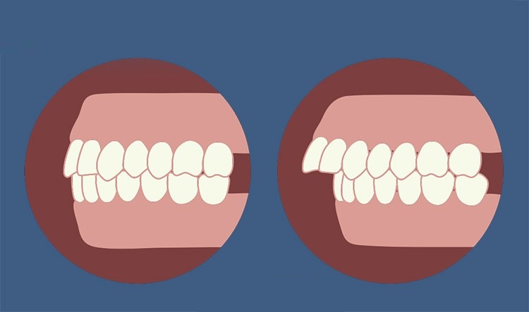 Nguyên nhân dẫn đến tình trạng răng hô - Ảnh 2