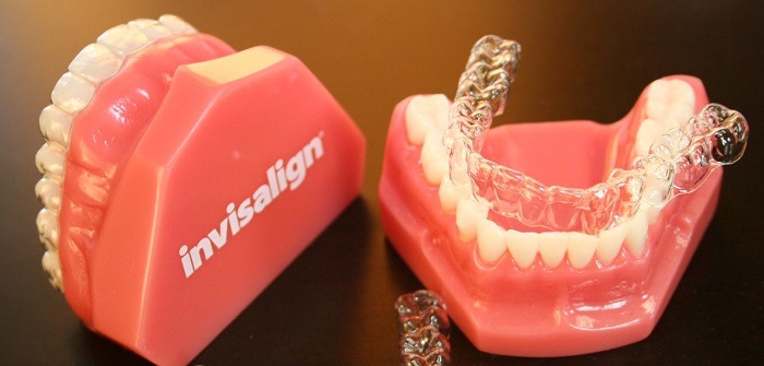 Những trường hợp nào nên niềng răng hàm dưới - Ảnh 2