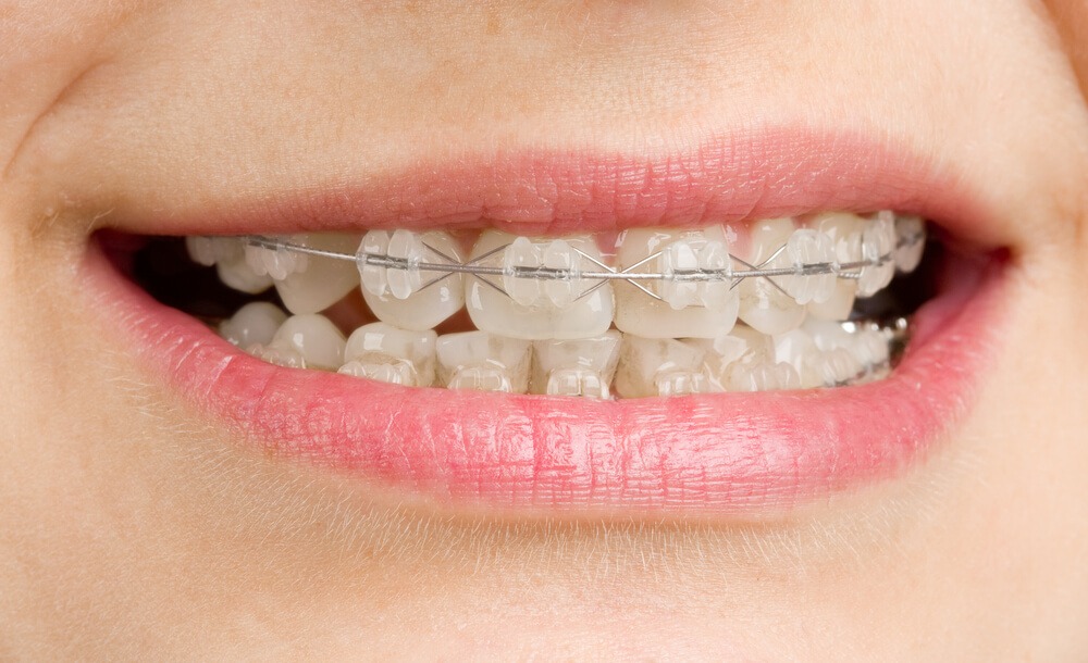 Các yếu tố ảnh hưởng đến giá tiền niềng răng mắc cài sứ - Ảnh 5
