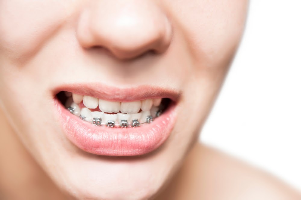 Rủi ro khi chỉ niềng răng 1 hàm - Ảnh 4