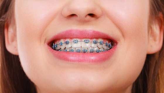 Niềng răng mắc cài kim loại có giá niềng răng phải chăng nhất trong các phương pháp niềng - Ảnh 1
