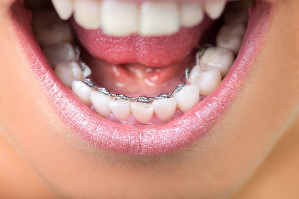 Giá tiền niềng răng mắc cài mặt trong dao động từ 50.000.000 - 70.000.000 đồng - Ảnh 3