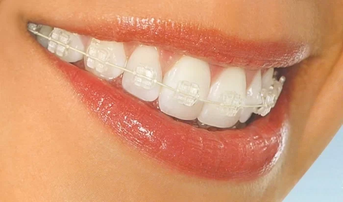 Niềng răng mắc cài sứ có tính thẩm mỹ cao, không lộ hằn lên răng như mắc cài kim loại