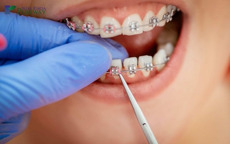 Niềng răng sớm cho trẻ em sẽ ngăn ngừa được nhiều vấn đề về răng miệng
