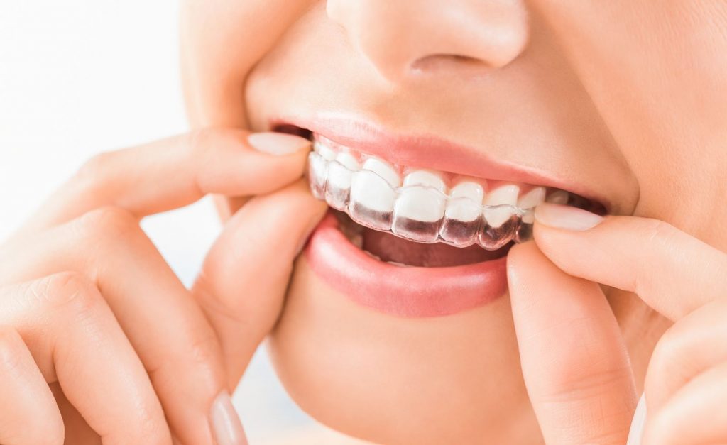 Giai đoạn gắn mắc cài niềng răng có thể xem là giai đoạn đau nhất