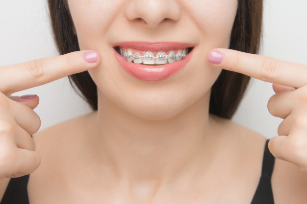 Giai đoạn gắn mắc cài niềng răng có thể xem là giai đoạn đau nhất