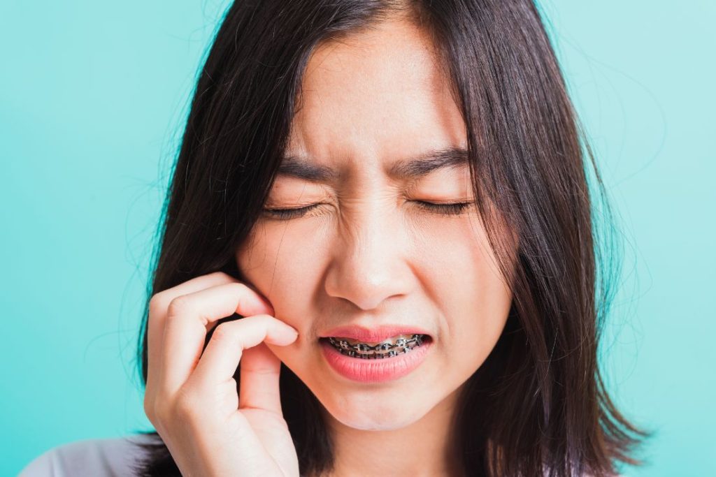 Niềng răng thường sẽ có cảm giác ê buốt trong 1 – 2 tuần đầu khi gắn mắc cài và dây cung