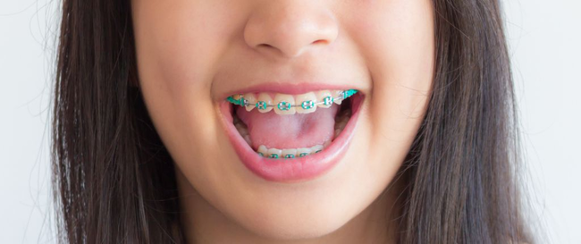 Quán trình niêng răng trải qua những giai đoạn nào