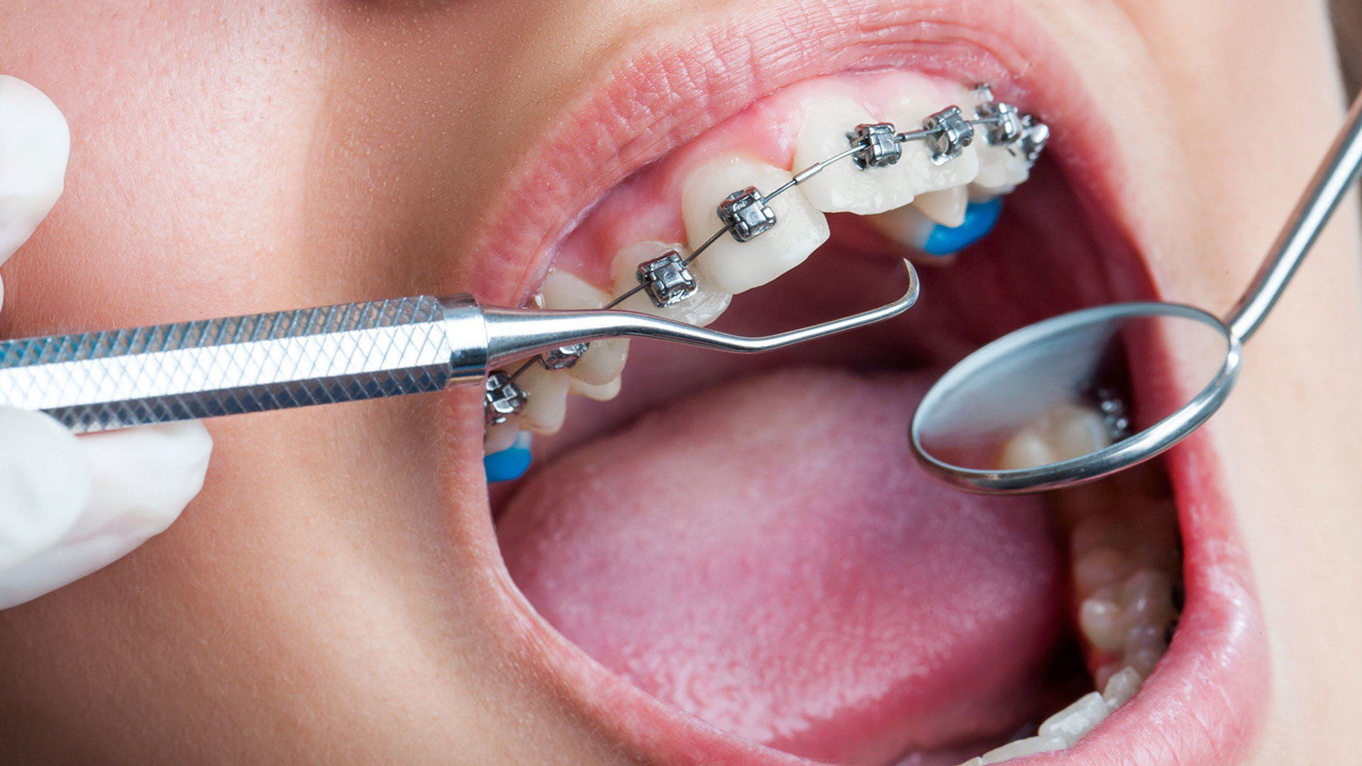 Điều trị chỉnh nha giúp ích gì cho tình trạng răng miệng?