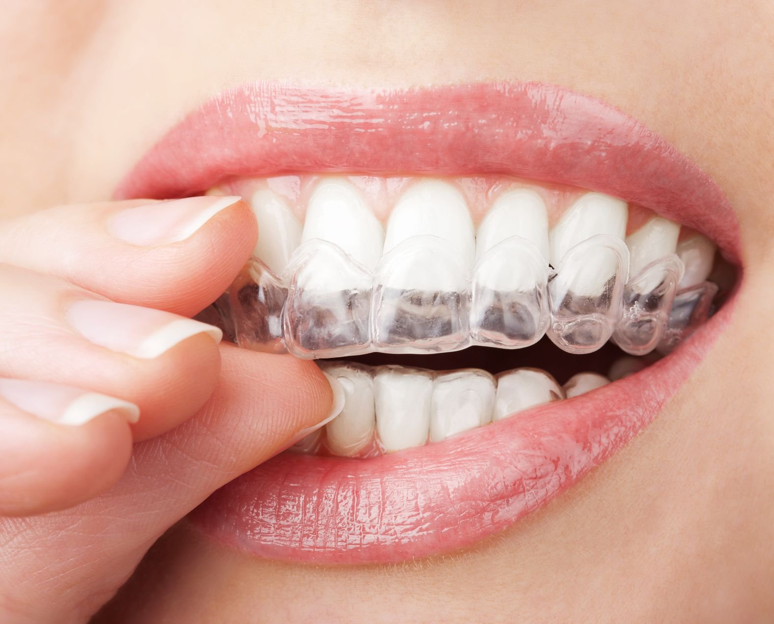 Sau niềng răng phải đeo hàm duy trì bao lâu?