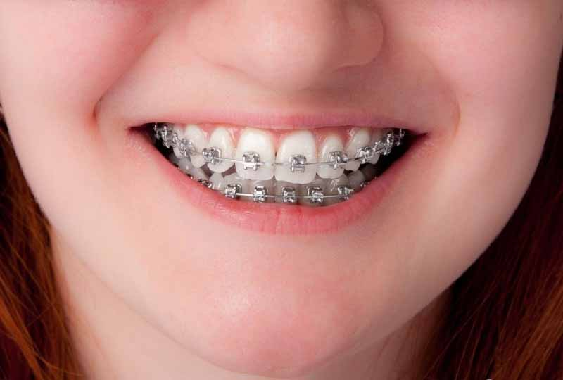 Quy trình niềng răng khớp cắn sâu ở trẻ em