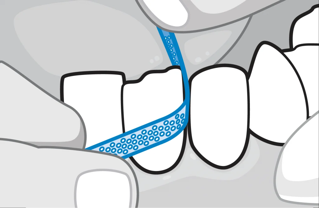 Niềng răng trong suốt Zenyum được xem là giải pháp niềng hạn chế nhổ răng tối đa nhờ áp dụng mài kẽ IPR