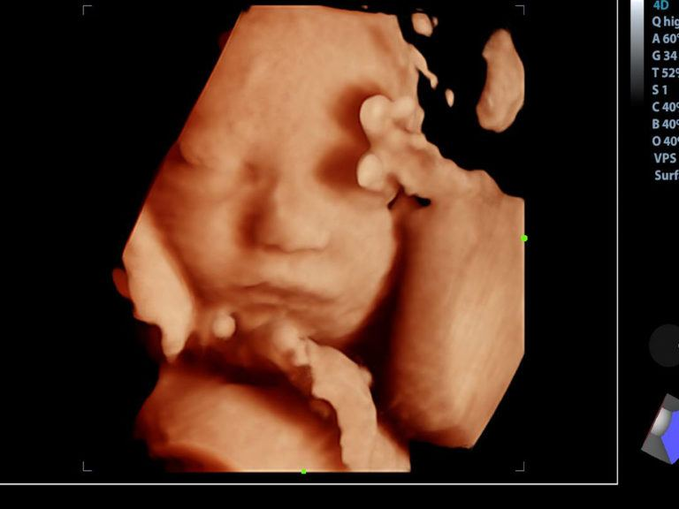 Hình ảnh siêu âm thai 22 tuần