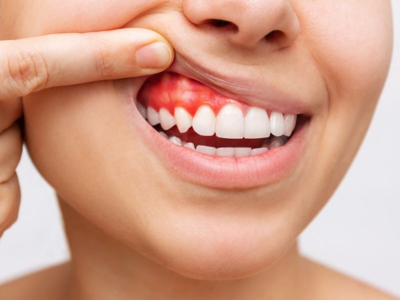 Nướu răng bị sưng lên là bệnh gì? Ngăn ngừa sưng nướu tại nhà